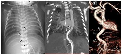 Frontiers Neonatal Arterial Tortuosity And Adult Aortic AneurysmIs There A Missing Link A